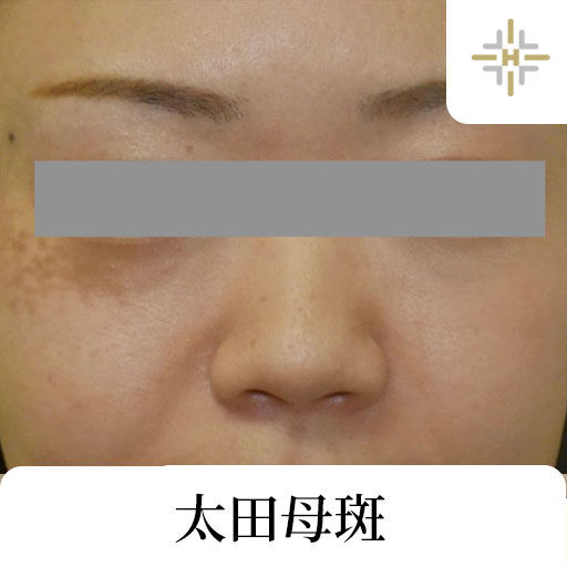 太田母斑（おおたぼはん） | ハルスクリニック あざ治療専門サイト