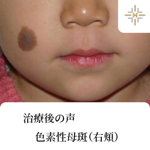 色素性母斑（右頬） | ハルスクリニック あざ治療専門サイト